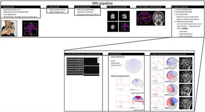 Evidence for the Role of Magnetic Source Imaging in the Presurgical Evaluation of Refractory Epilepsy Patients